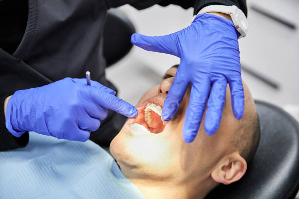 Best Emergency Wisdom Tooth Extraction in Hamilton, OH